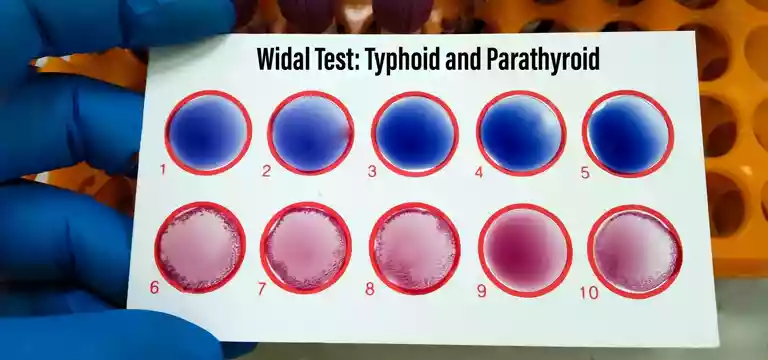 Widal test: What is it, Uses, Normal range, Widal test near you